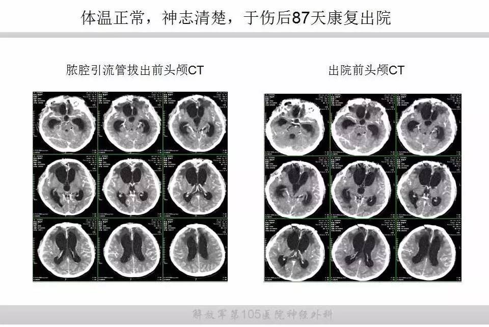 【京出现一例重型病例,北京协和医院发现一例】 【京出现一例重型病例,北京协和医院发现一例】